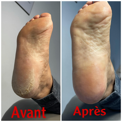 Baume Réparateur pour Pieds | 1 Acheté = 1 Chaussette Offert