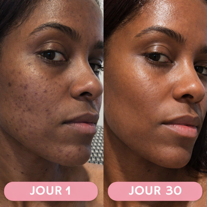 Baguette Haute Fréquence